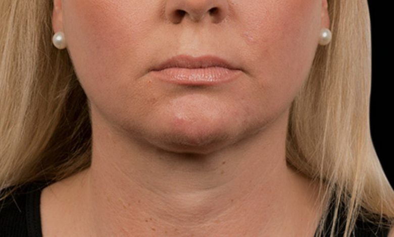 Coolsculpting For Chin Cost