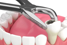 tooth extractions aftercare