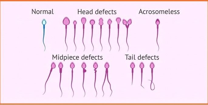 Normal Sperm Morphology Analysis